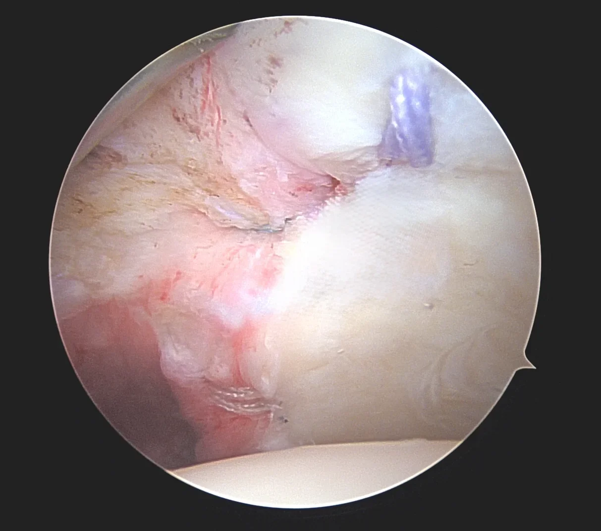 Réparation du labrum sur ancres – vue arthroscopique Vue arthroscopique de l’épaule : réparation du labrum supérieur sur ancres chirurgicales pour une lésion SLAP