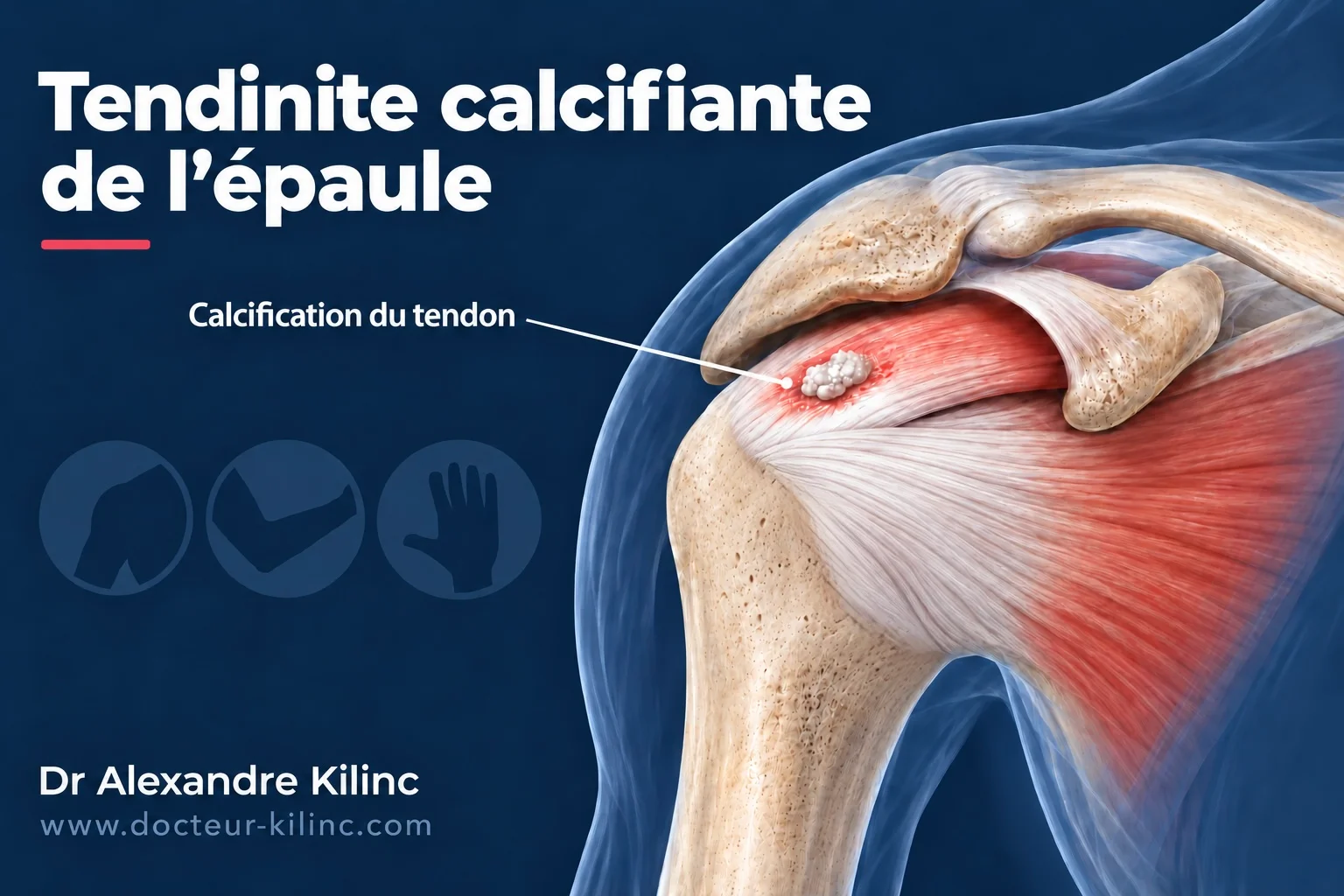 Tendinite calcifiante de l’épaule — calcification du tendon supra-épineux Tendinite calcifiante de l’épaule : calcification dans le tendon supra-épineux de la coiffe des rotateurs, sous l’acromion