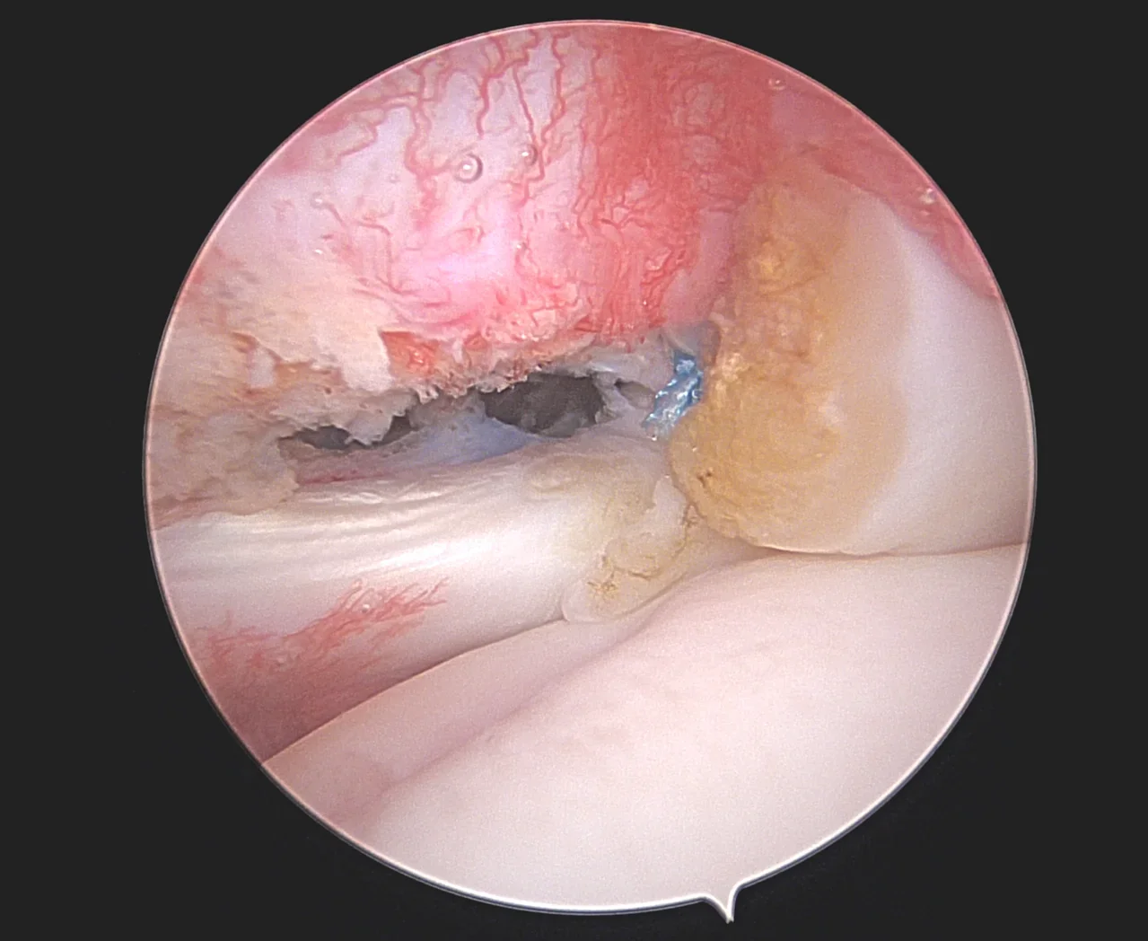 Ténodèse du long biceps – vue arthroscopique Vue arthroscopique de l’épaule : ténodèse du long biceps réalisée pour traiter une lésion SLAP